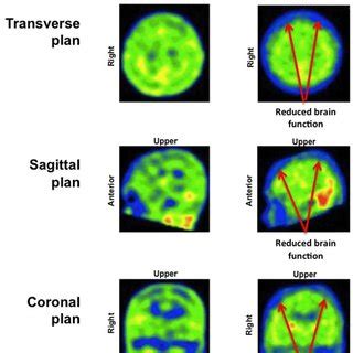 18 F-FDG PET scan of the brain of a female patient affected by osmotic... | Download Scientific ...