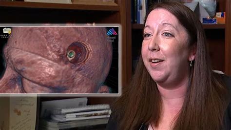 Woman Relieved After Brain Tumor Turns Out To Be Parasite Youtube