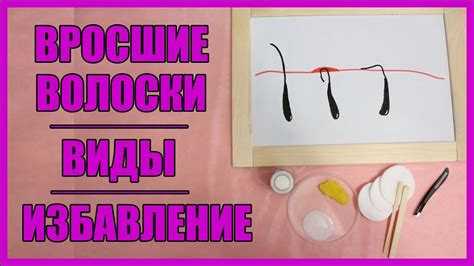 Вросший волос. Виды. Как избавиться - YouTube