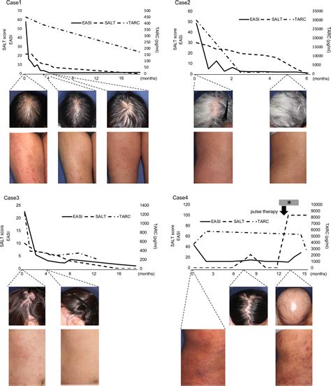 Twosided Influence Of Dupilumab On Alopecia Areata Coexisting With