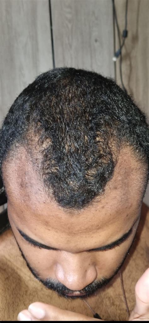 Minoxidil 3 Months R Minoxidil