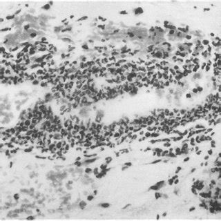 Histology of the Arthus reaction in skin, treated with PBS (positive ...