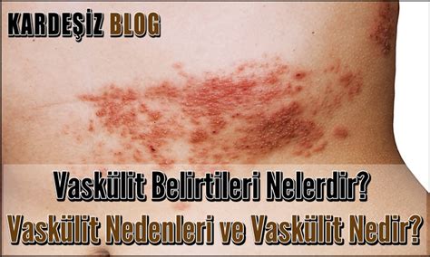 Vaskülit Belirtileri Nelerdir Vaskülit Nedenleri ve Vaskülit Nedir