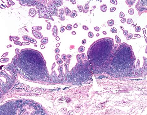 Mantle Cell Lymphoma Light Micrograph Stock Image C0572858