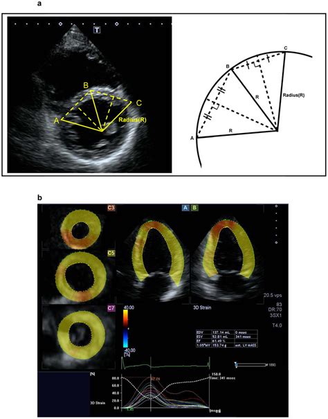 Two Dimensional Echocardiographic Assessment Of Ventricular Septal