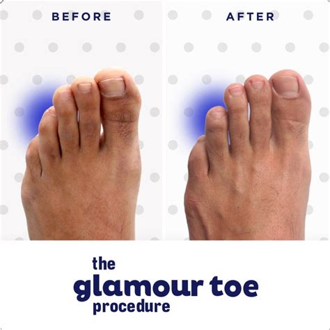 Hallux Varus | Procedures in NYC & Beverly Hills | Dr Neal Blitz