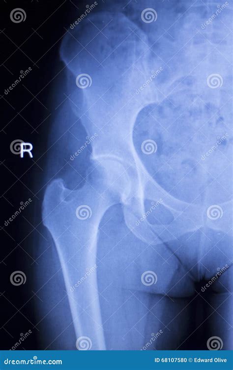 Hip Injury Xray Medical Scan Stock Photo Image Of Diagnosis Science