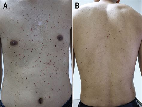 Eruptive Cherry Angiomas After Nitrogen Mustard Treatment Ccid