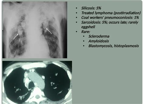 Silicosis Eggshell Calcification