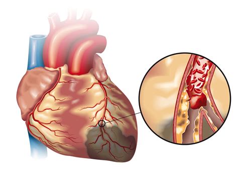 Koronare Herzerkrankung Herzinfarkt Angina Pectoris Herzclinic