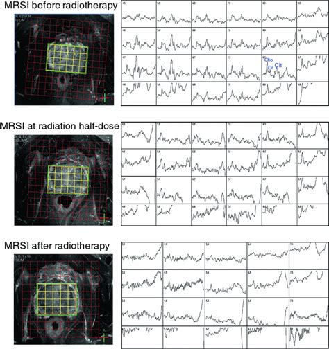 Imaging And Mr Spectroscopy In Prostate Cancer Radiology Key