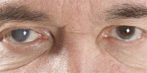 How To Get Rid Of Cataract Without Surgery Tribeca Care