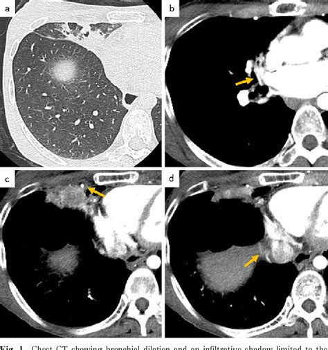 Figure 1 From A Case Of Bronchiectasis With Right Middle Lobe Resection