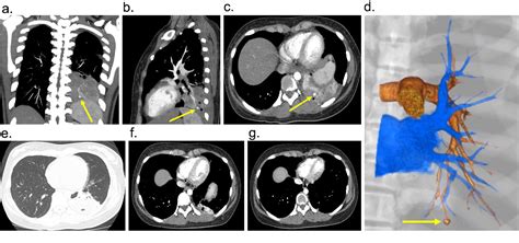 Figure 3 From Infectious Pulmonary Artery Pseudoaneurysm That Resolved With Conservative