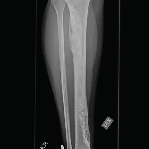 Preoperative X-ray from a right tibia. A plain X-ray from a right tibia ...