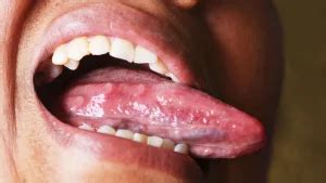 Porque Nascem Aftas Na Lingua - Aftas en la lengua: causas, síntomas y tratamientos efectivos - MIO