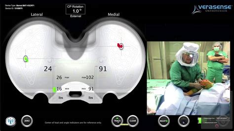 Verasense Combination Knee Varus In Flexion Valgus In Extension