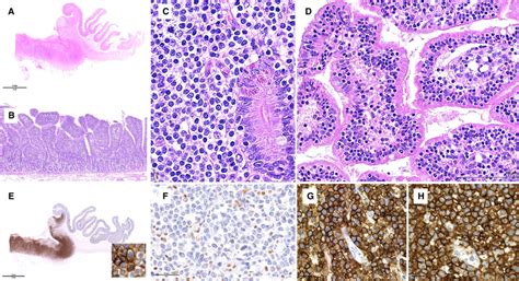 Monomorphic Epitheliotropic Intestinal T Cell Lymphoma AB Typical