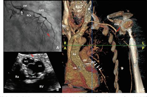 Infective Endocarditis With Perivalvular Abscess Complicated By Septic Embolization With Acute