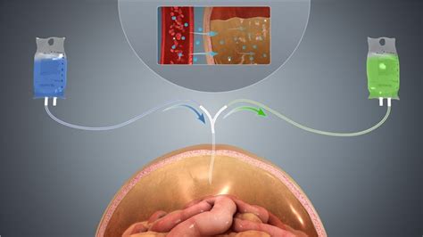 Peritonitis Model Creative Diagnostics