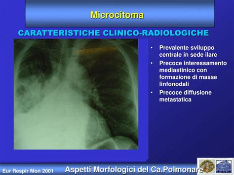 Ppt Diagnosi E Stadiazione Del Tumore Polmonare Powerpoint