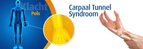 Carpaal Tunnel Syndroom Wat Is Het Podobrace