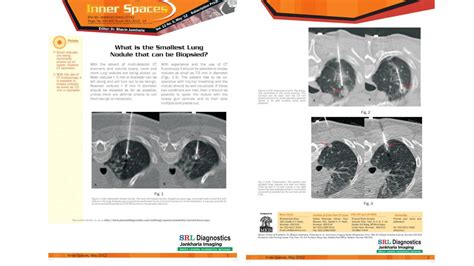 Ct Guided Biopsies Precise Tissue Sampling Procedures In Mumbai