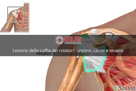 Ancora Reddito Sospetto Lesione Cuffia Dei Rotatori Spalla Ruotare