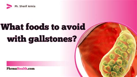 How To Prevent Gallstones Phrmahealth