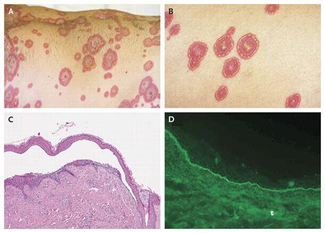 Linear IgA Bullous Disease — NEJM | Disease, Iga, Autoimmune disease