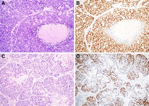 Basaloid Scc Demonstrates An Adenoidal Growth Pattern With Peripheral