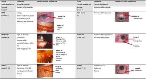 Risk Factors For Bleb Related Infection Following Trabeculectomy