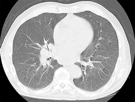 High‐resolution Ct Hrct Of The Chest Showing Hilar Lymphadenopathy Download Scientific Diagram