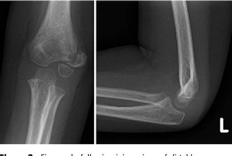 Figure 2 from Lateral condyle fracture of a child's humerus: the radiographic features may be ...