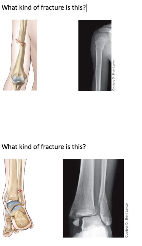 Solved In terms of a closed fracture, open fracture, | Chegg.com