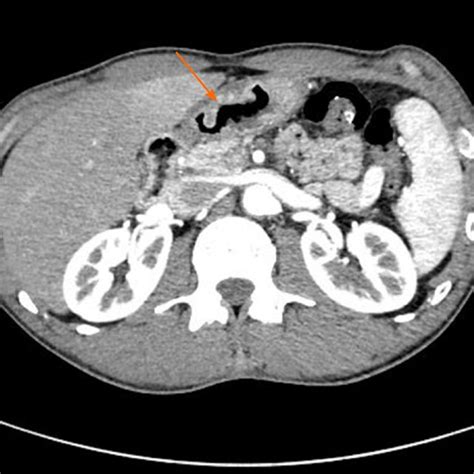 Findings From Preoperative Abdominal Computed Tomography Abdominal Download Scientific Diagram