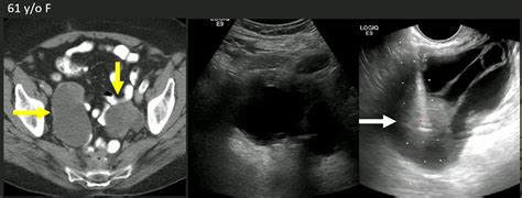 Tvus Guided Transvaginal Biopsy Safe Effective For Pelvic Lesions