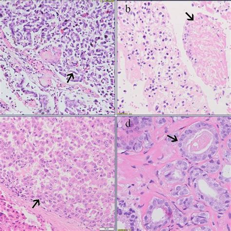 A Metastatic Pulmonary Osteosarcoma Arrow H E 20 B Tumor