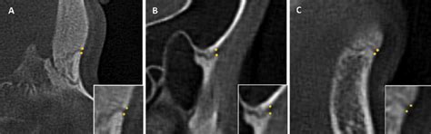 Sagittal Cbct Sections Showing A The Frontonasal Suture B The