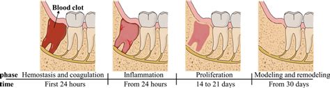 Main Processes Of Wound Healing Occurring In The Socket After Tooth