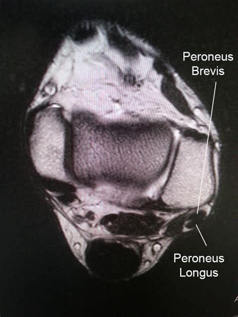 Peroneus Tertius Tendon