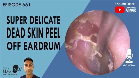 661 Super Delicate Dead Skin Peel Off Eardrum Youtube