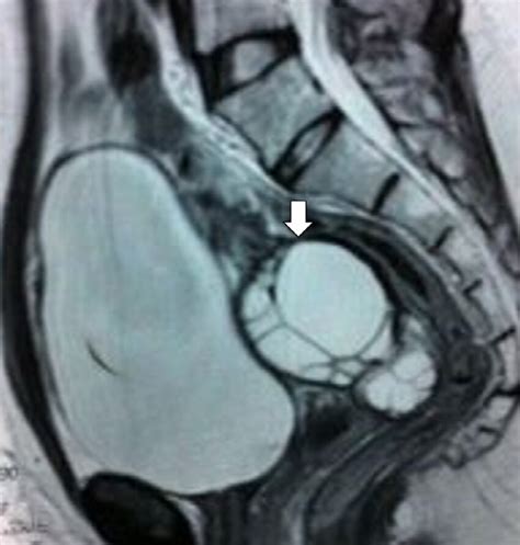 Pelvic MRI In T2 Weighted Images In Sagittal Plan Showing A Cystic