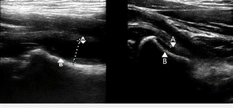 Ultrasound demonstrating a hip joint effusion in a paediatric patient... | Download Scientific ...