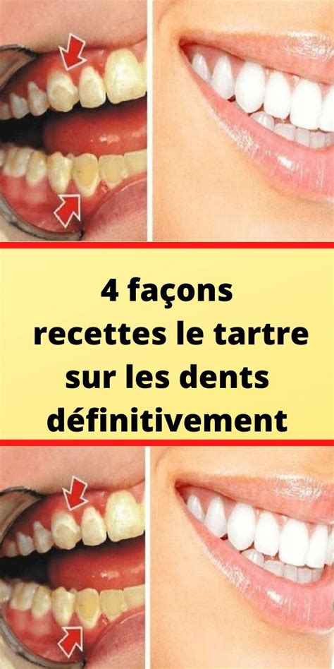 4 façons recettes le tartre sur les dents définitivement haustiersos