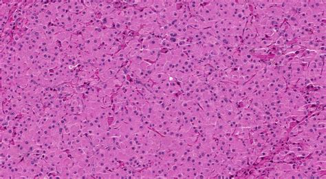 Leydig Cell Tumour Of The Testis Ottawa Atlas Of Pathology