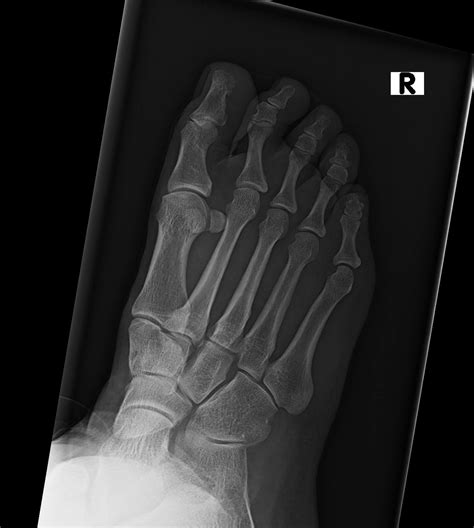 Orthodx Foot Pain While Walking Running Clinical Advisor