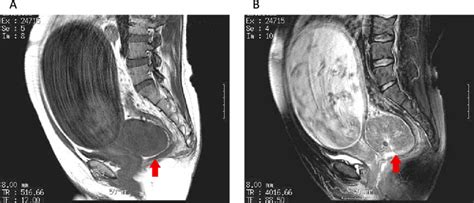 Mri Of The Pelvis A T1 Weighted B T2 Weighted The Mri Showed Left