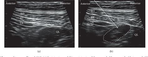 Figure 2 From Ultrasound Guided Quadratus Lumborum Block An Updated