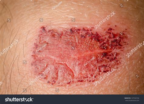 Medical Incrustation Scab Skin Patient Stock Photo 107534156 - Shutterstock